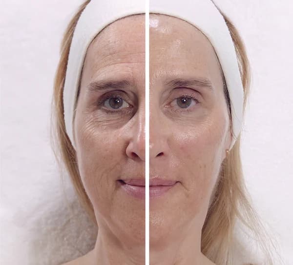 Visible Age Reverse and Hydradermie Lift results